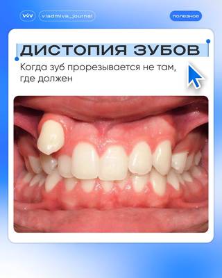 Дистопия зуба. Диагностика и тактика врача.